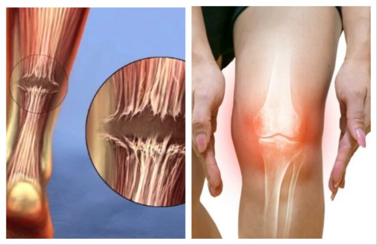 अवांतर, मराठी कथा, मराठी साहित्य, मराठी लेखक, मी मराठी, मराठी लेख, अभिजात मराठी, टेंन्डो एकियालीस, एसीएल, पोटरीखाली घोडशीर,